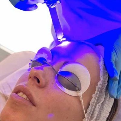 Tratamiento-Facial-Láser-Azul